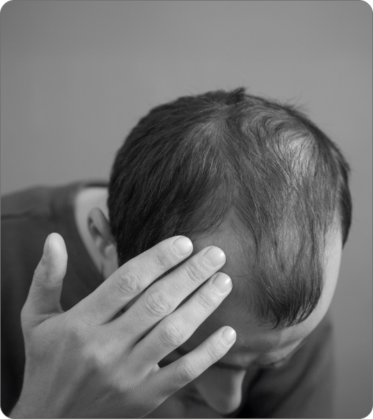 Male Hair Loss